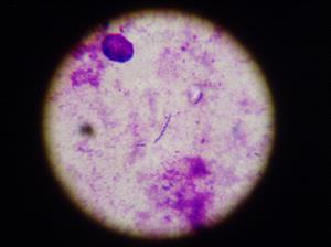 Microscopic image of gastric endoscopy biopsy smear