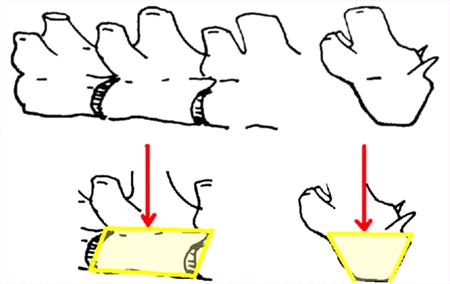 Drawings of normal vertebrae and of hemivertebra that has not developed symmetrically, leading to a wedge shape