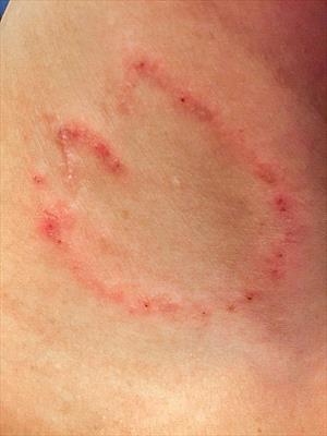 ringworm-on-human-skin