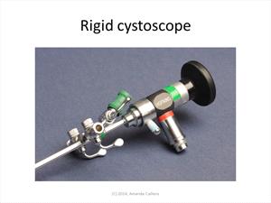 A picture of a rigid cystoscope used to see stones inside the bladder.