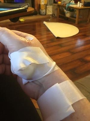 wrist-and-hand-injuries