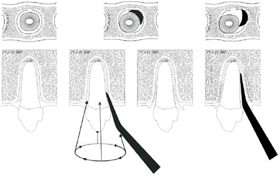 Figure 1. Luxation technique