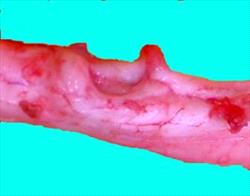 Gross Pathology, Spinal Cord