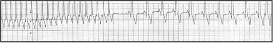 Figure 4. Supraventricular tachycardia.