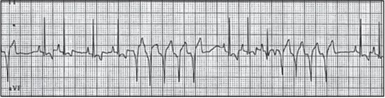 Figure 7. Paroxysmal ventricular tachycardia (dog).