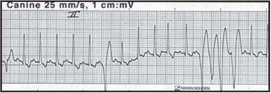 Figure 8. Four closely coupled ventricular complexes, indicating an electrically unstable rhythm.