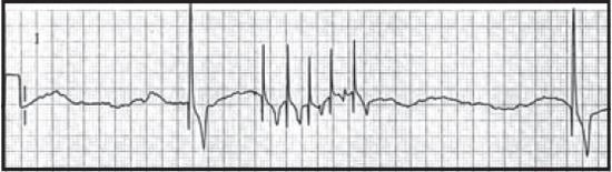 Figure 1. Sick sinus syndrome.