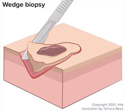 Wedge biopsy technique