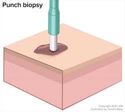 Punch biopsy technique