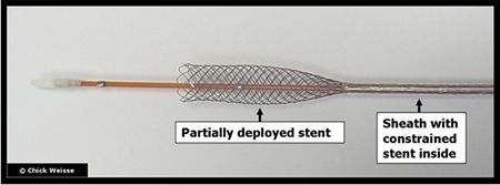 Figure 1. Self-expanding metallic stent.