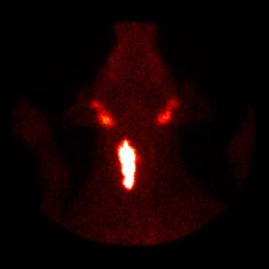 Canine thyroid carcinoma imaged by scintigraphy.